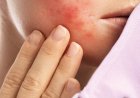 Was bedeutet zystische Akne auf den Wangen?