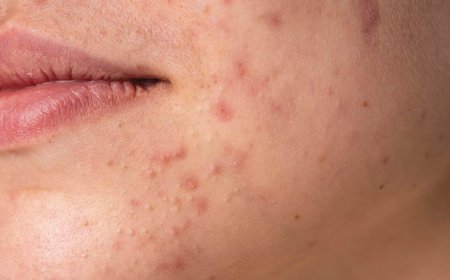 Pouvez-vous faire éclater l'acné kystique ?