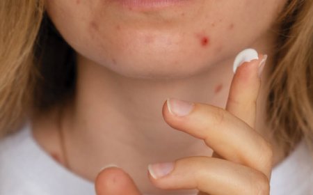 A quel âge l'acné doit-elle cesser ?