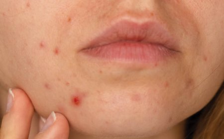 Un dermatologo può davvero aiutare la mia acne?