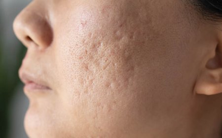 L'acqua aiuta l'acne?