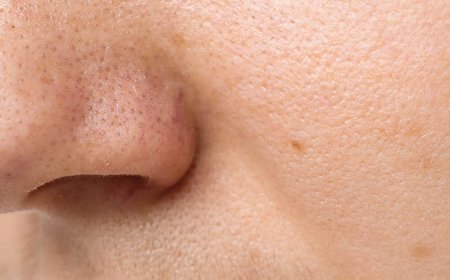 Helpt water drinken bij acne?