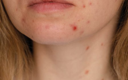 L'acne batterica può scomparire da sola?