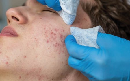 Come fanno i dermatologi a sbarazzarsi dell'acne?