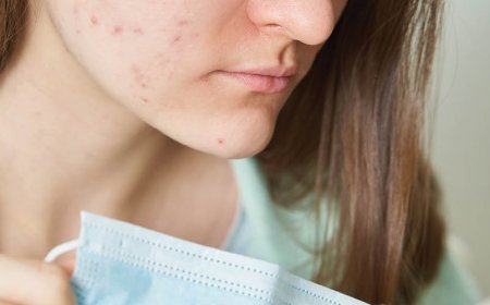 Lavarsi il viso peggiora l'acne?