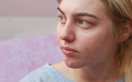 L'ansia può causare l'acne?