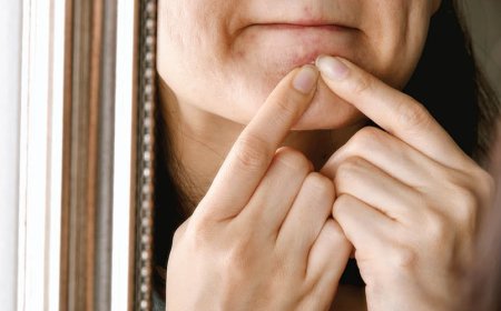 Lo zucchero causa l'acne?