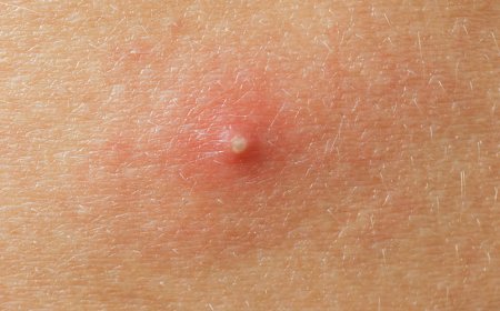 Come faccio a sapere se la mia acne è batterica o fungina?