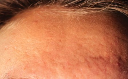 Il caffè causa l'acne?