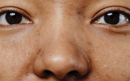Gli estrogeni bassi causano l'acne?