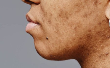 Hoe weet ik of mijn acne bacterieel of hormonaal is?
