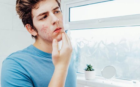 La doxiciclina può trattare l'acne ormonale?