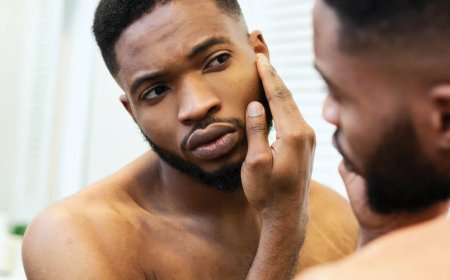 Ci sono alimenti che causano l'acne cistica?
