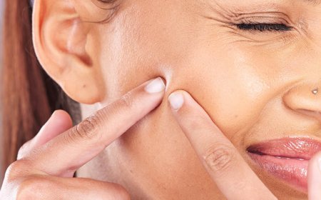 Quanto tempo ci vuole perché l'acne scompaia?