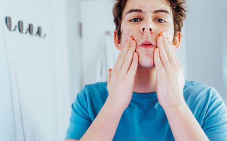 Hoe komt u op natuurlijke wijze in 3 dagen van acne af?