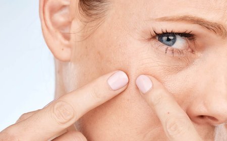 Per quanto tempo si può assumere la doxiciclina per l'acne?
