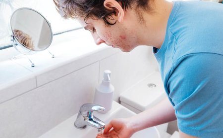 Quanto tempo deve rimanere l'acne?