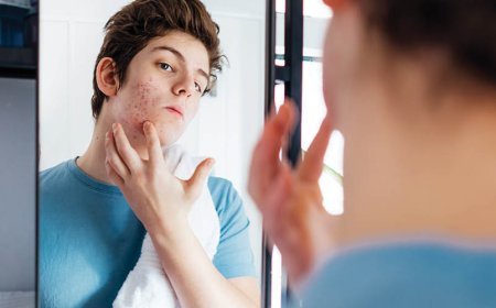 Hoe weet ik of mijn acne ernstig is?