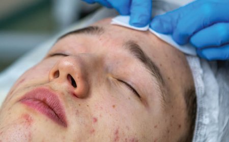 Hoe voorkomt u cystische acne?