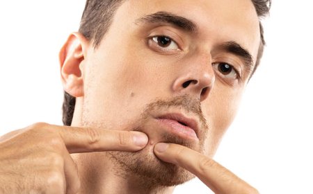 In quanto tempo l'acne scomparirà?