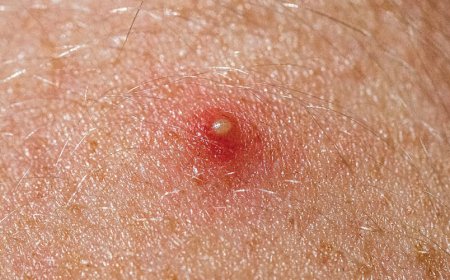 È meglio la doxiciclina o l'Accutane?
