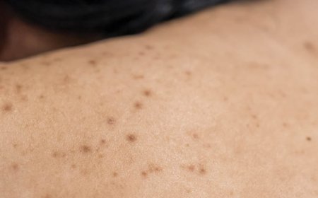 La mia acne è ormonale o fungina?
