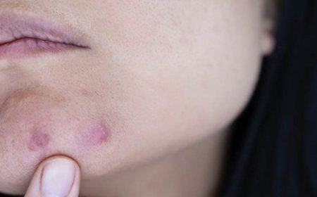Que signifie l'acné au menton ?
