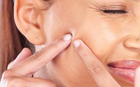 De quoi se nourrissent les bactéries de l'acné ?