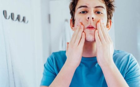 A che età l'acne è peggiore?