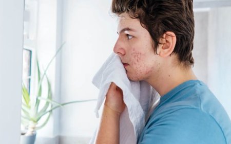 Quali sono i tre principali fattori scatenanti dell'acne?