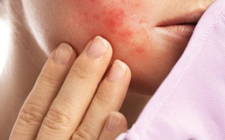 Que signifie l'acné kystique sur les joues ?