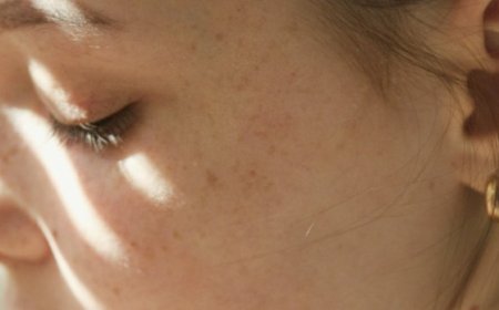 Quali sono i batteri che causano la maggior parte dell'acne?