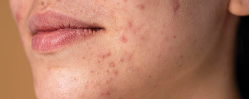 Kunt u cystische acne laten opspringen?
