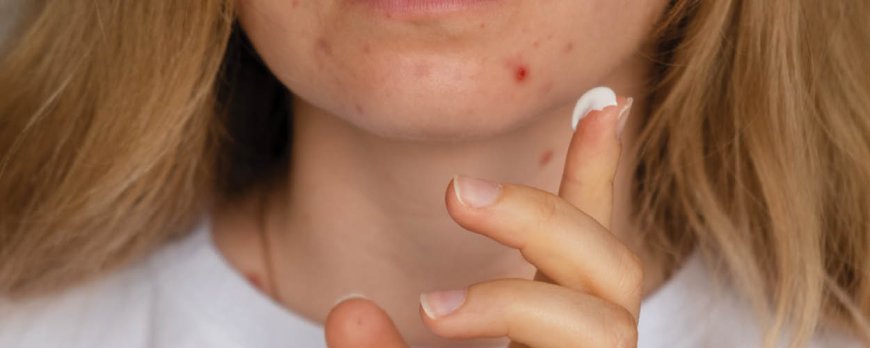 Op welke leeftijd moet acne stoppen?