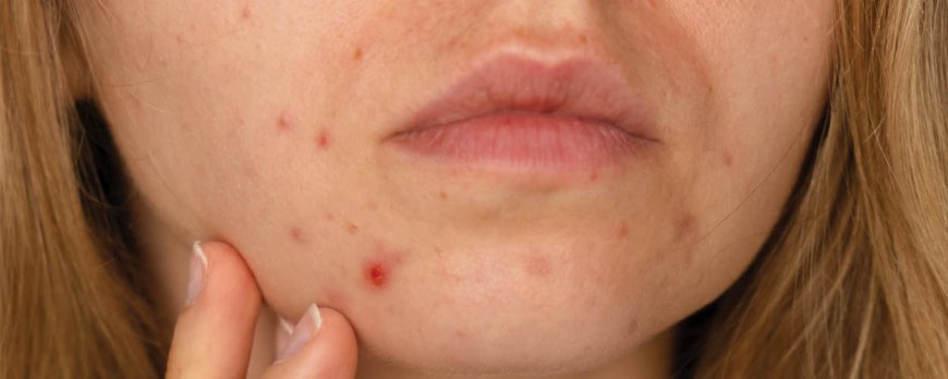 Can a dermatologist really help my acne?