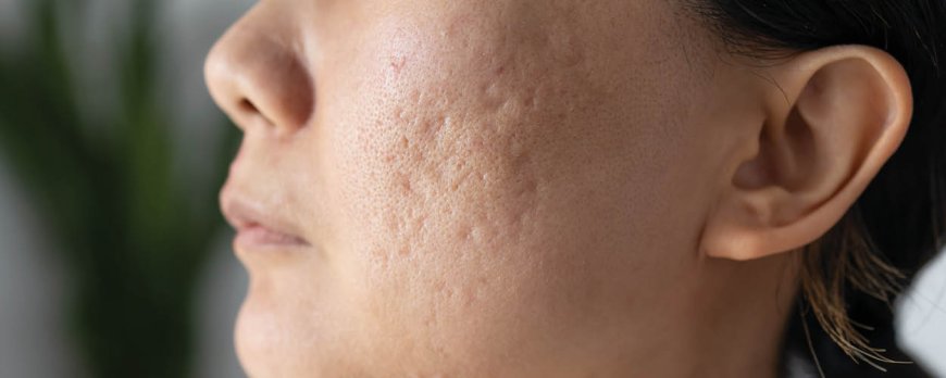 Helpt water bij acne?