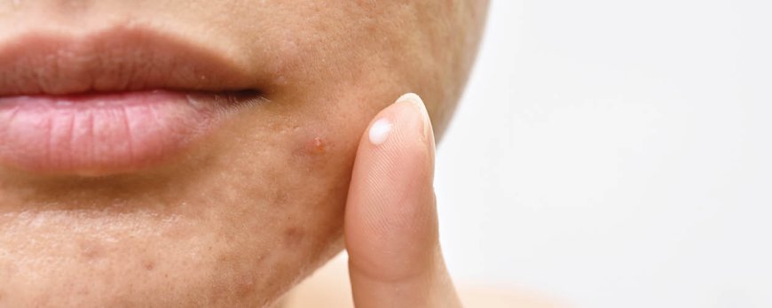 Hoe kan ik mijn huid beschermen tegen doxycycline?