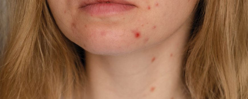 Can bacterial acne go away on its own?