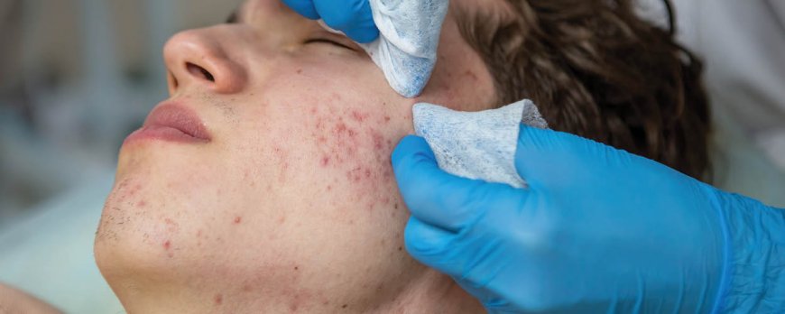 How do dermatologists get rid of acne?