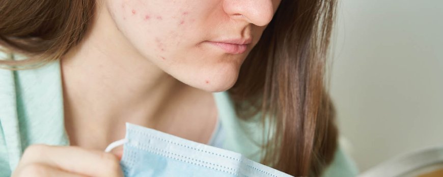 Does washing your face make acne worse?