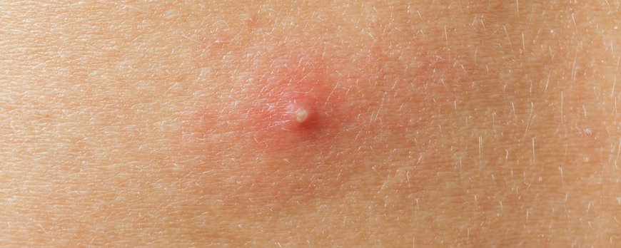 Comment savoir si mon acné est bactérienne ou fongique ?