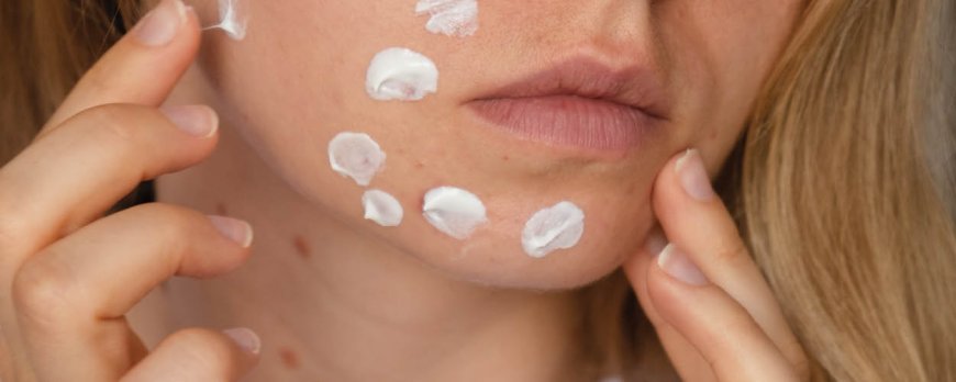 Does moisturizer help with acne?