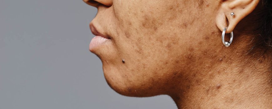 How do I know if my acne is bacterial or hormonal?