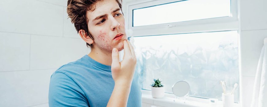 Kan doxycycline hormonale acne behandelen?