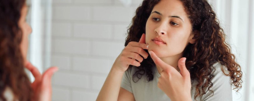 How do I know my acne is hormonal?