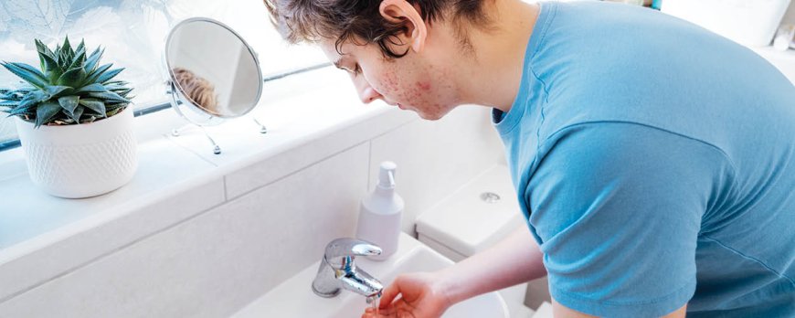 How long should acne stay?