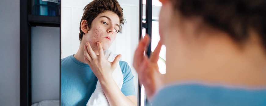 Come faccio a sapere se la mia acne è grave?