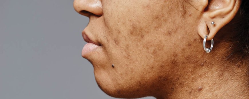 How do you know when acne is healing?