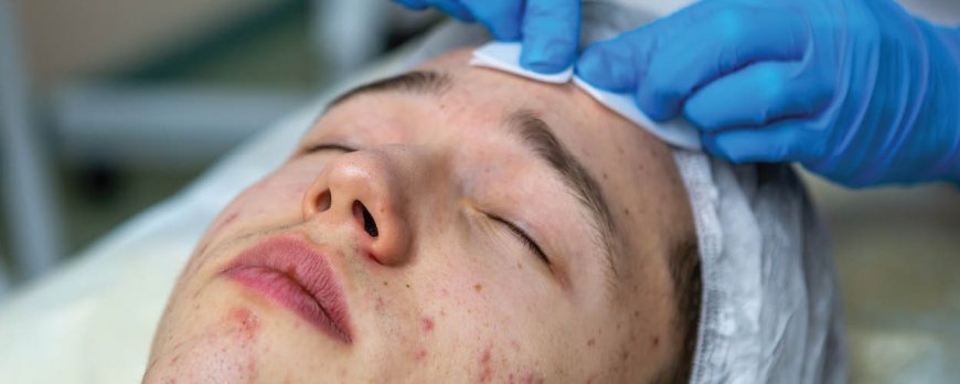 How do you break up cystic acne?