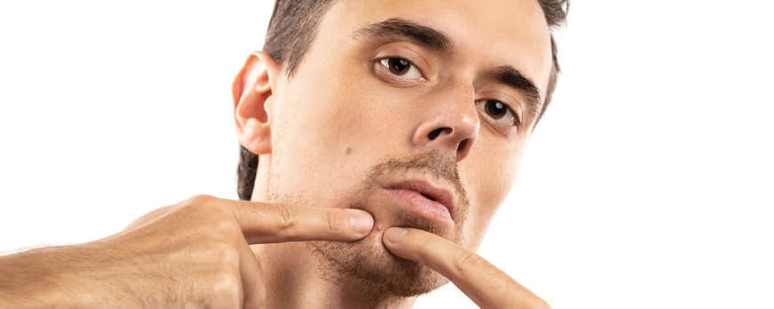 How long will acne clear up?